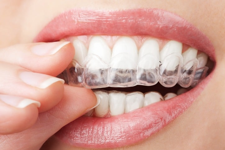 How Much Does Invisalign Cost in Canada? - Dentist North York
